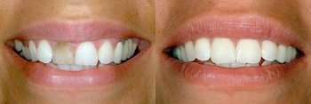 Smile Gallery - Baker Hill Dental, Glen Ellyn Dentist