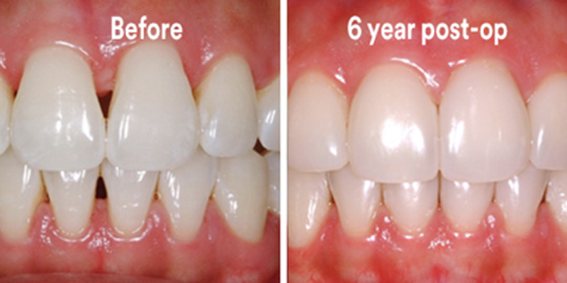 BioClear Diastema Closure and Black Triangle Closure  - Baker Hill Dental, Glen Ellyn Dentist