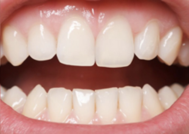 Cosmetic Bonding  - Baker Hill Dental, Glen Ellyn Dentist