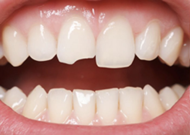 Cosmetic Bonding  - Baker Hill Dental, Glen Ellyn Dentist