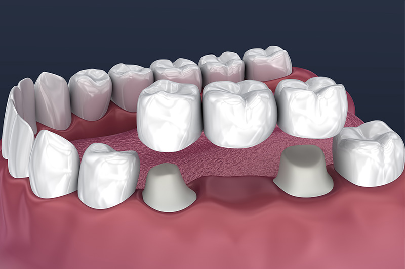 Crowns and Bridges, Inlays and Onlays  - Baker Hill Dental, Glen Ellyn Dentist