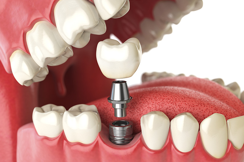 Dental Implants - Baker Hill Dental, Glen Ellyn Dentist