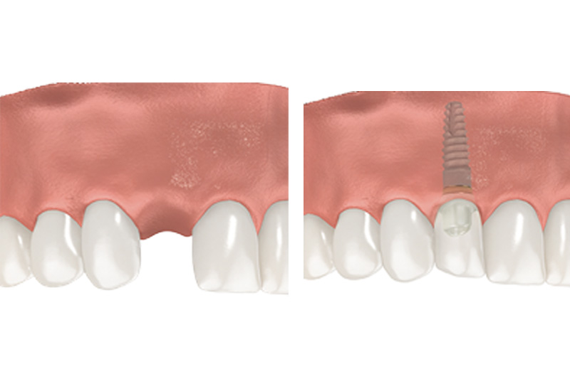 Dental Implants - Baker Hill Dental, Glen Ellyn Dentist