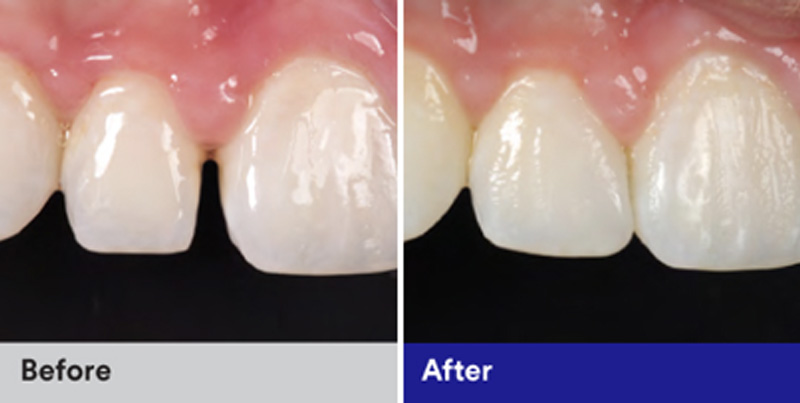 BioClear Diastema Closure and Black Triangle Closure  - Baker Hill Dental, Glen Ellyn Dentist