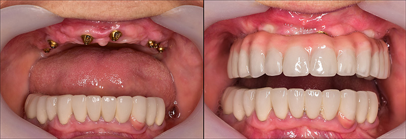 Implant Overdentures and Fixed All-On-X Treatment  - Baker Hill Dental, Glen Ellyn Dentist