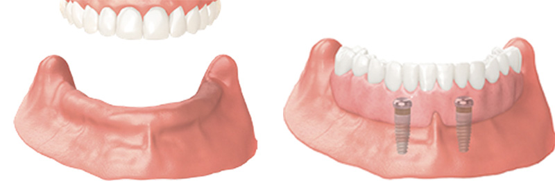 Implant Overdentures and Fixed All-On-X Treatment  - Baker Hill Dental, Glen Ellyn Dentist