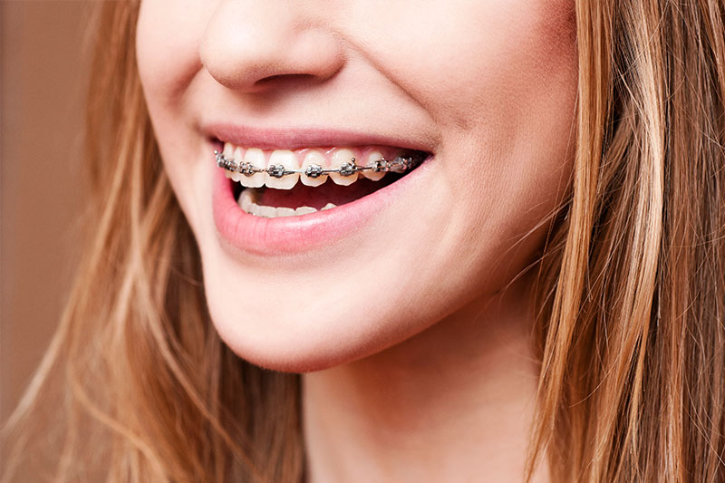 Orthodontics - Baker Hill Dental, Glen Ellyn Dentist