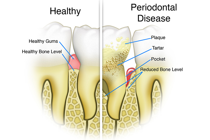 Scaling & Root Planings (Deep Cleanings)  - Baker Hill Dental, Glen Ellyn Dentist