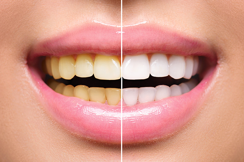 Teeth Whitening - Baker Hill Dental, Glen Ellyn Dentist