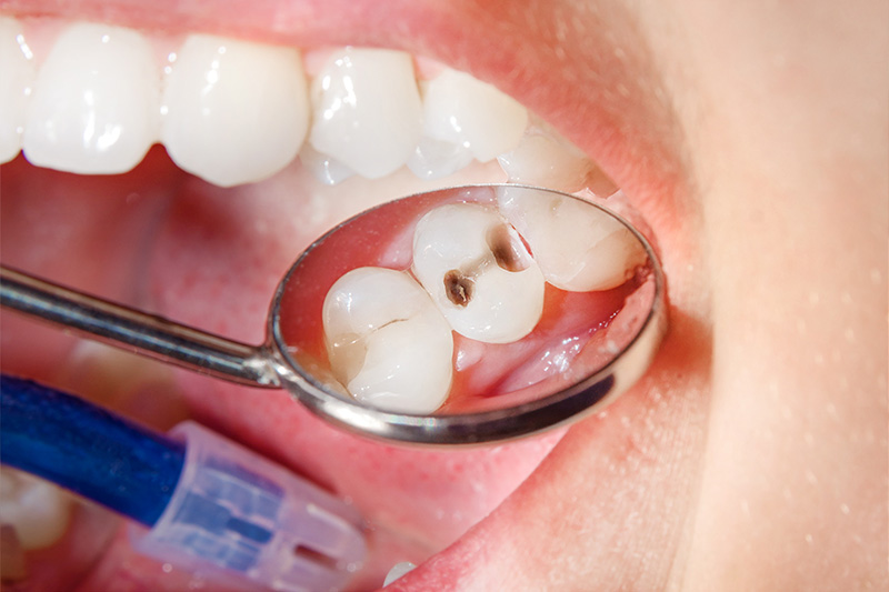 Tooth Colored Composite Fillings  - Baker Hill Dental, Glen Ellyn Dentist