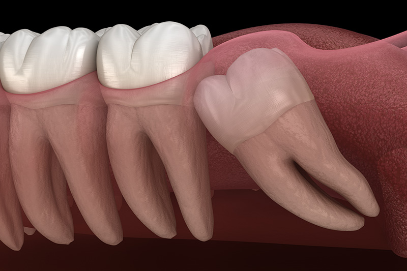 Wisdom Teeth Extractions (with Sedation)  - Baker Hill Dental, Glen Ellyn Dentist